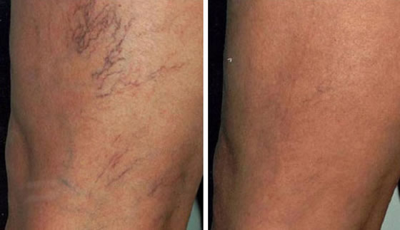 Laser Thread Vein Removal - Horsham, Crawley, Dorking, Surrey, West Sussex