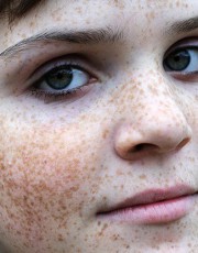 Laser freckles Removal