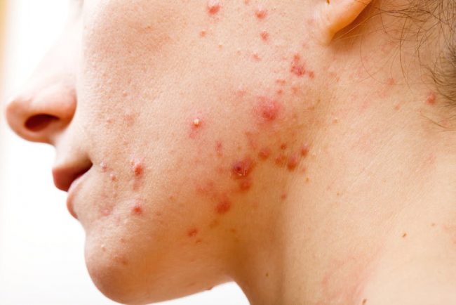 Acne Patients on Treatment too long