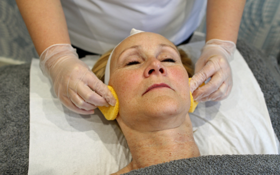 Preparing for Skin Peel