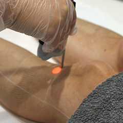 laser-hair-removal-lead