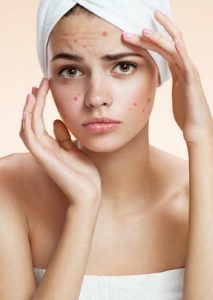 Teenager with acne treatment