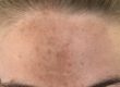 Pigmentation Removal