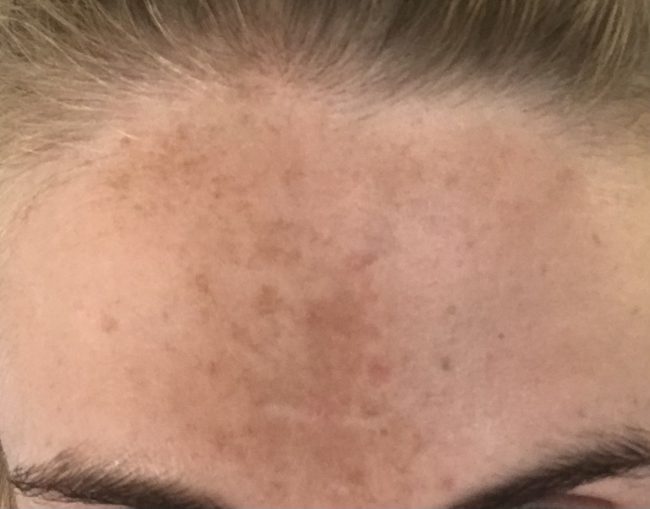 4914E731-38DE-4798-A8BB-A80D08190BD3_1_201_a Pigmentation Removal